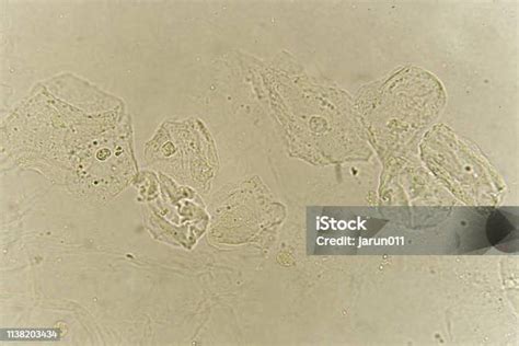 Sel Epitel Dengan Bakteri Dalam Urin Pasien Foto Stok Unduh Gambar Sekarang Analisis