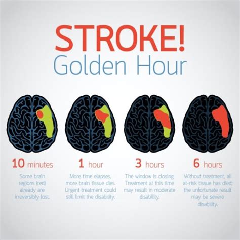 8 Important Facts You Need To Know About Stroke 8listph