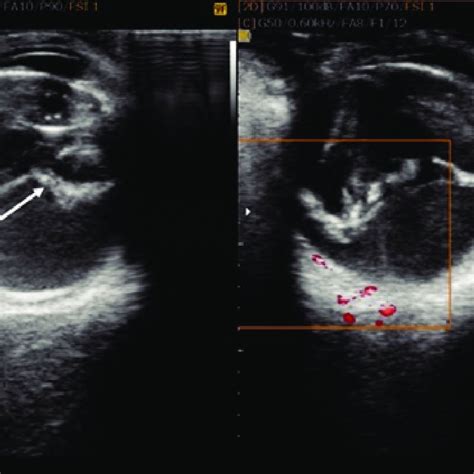 Color Doppler Ultrasonography Shows No Flow In The Membrane Seen In The