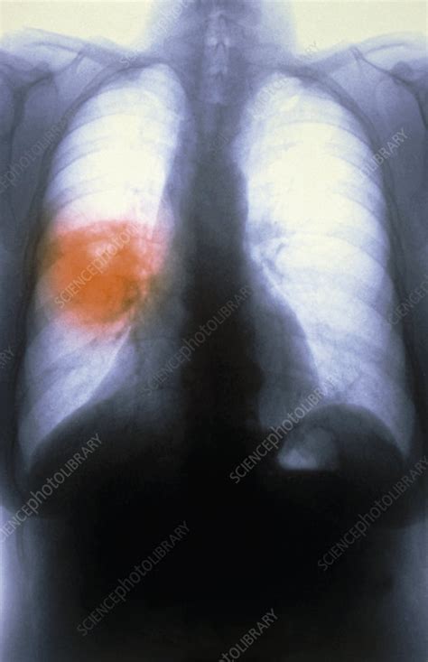 Lung Cancer X Ray Stock Image M1340524 Science Photo Library