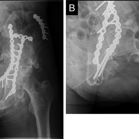 A Anteroposterior And B Lateral Pelvic Radiographs Before Ho