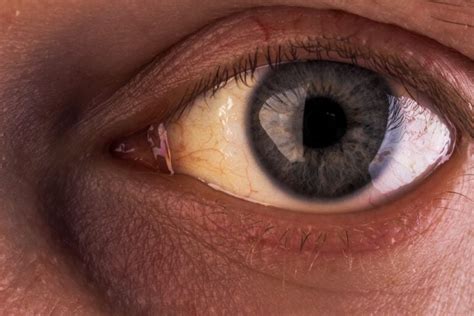 Yellow Eyes Common Causes And When To See A Doctor