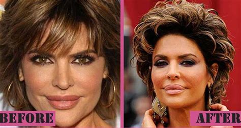 Lisa Rinna Plastic Surgery Botox Lip Fillers Photos After And Before