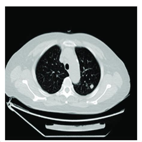 Chest Ct Showed That A Soft Tissue Nodule In The Left Upper Lobe With