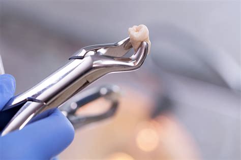 Chirurgia Stomatologiczna Kielce Ideal Dent