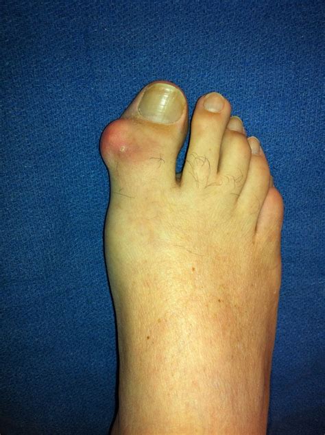 What Is Gout And Foot Surgery For Gout City Footcare Nyc Nycs