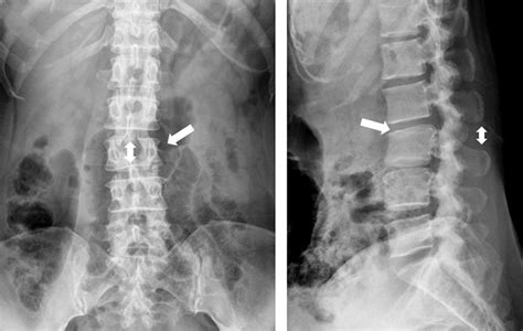 Anteroposterior A And Lateral B Radiographs Of The Lumbar Spine At