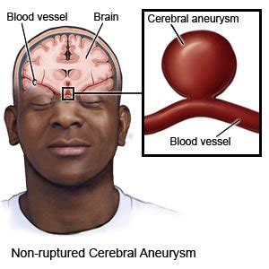 Nonruptured Cerebral Aneurysm What You Need To Know