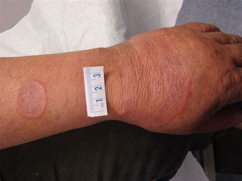 Ring Shaped Lesions On A Mans Arm