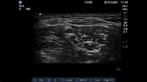 Ultrasound Guided Interscalene Brachial Plexus Block Video My XXX Hot