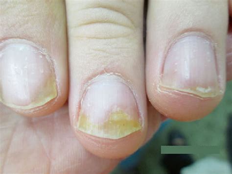 Nail Psoriasis Causes Symptoms Diagnosis Treatment And Prognosis