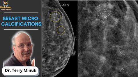 Breast Microcalcifications Mammography Dr Terry Minuk Radiogyan