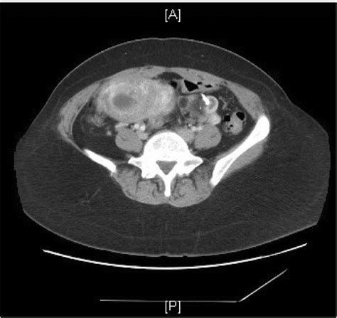 Hyperthyroidism In A Complete Molar Pregnancy With A Mature Cystic My