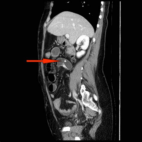 Double Contrast Computed Tomography Scan With A Sagittal View Of The