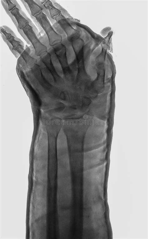 X Rayed Human Left Hand X Ray Of Hand Bones Stock Image Image Of
