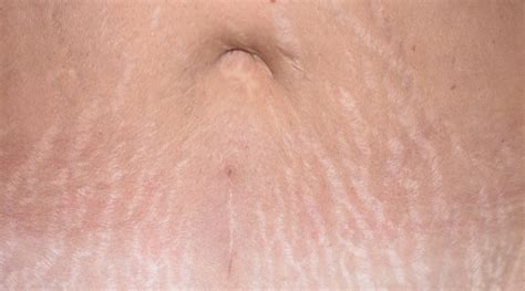 Stretch Marks Pure Dermatology Metairie La