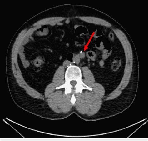 Computed Tomography Of The Abdomen Showing An Enlarged Retroperitoneal