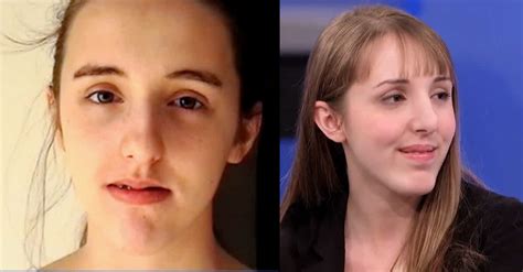 Teen Bullied For Her Large Nose Gets Corrective Surgery