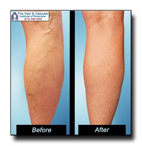 Does Insurance Cover Spider Vein Removal Hegwer