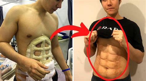 This Cosmetic Clinic Is Offering An Instant 6 Pack Surgery Option Youtube