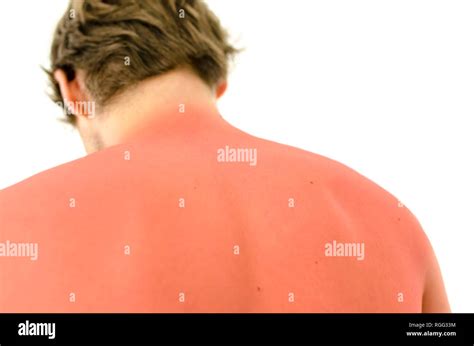 Get Sunburned Hi Res Stock Photography And Images Alamy