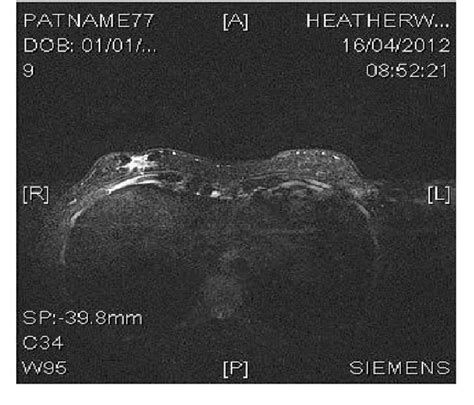 Pdf Primary Ectopic Breast Carcinoma In A Supernumerary Breast