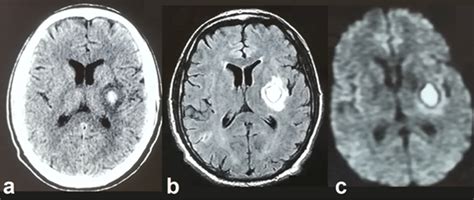 Bleeding Transformation Of The Infarction At Left Basal Ganglia A