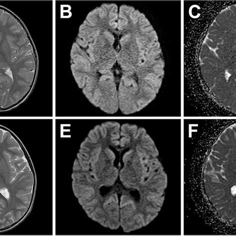 Brain Mri Findings Of The Patient Brain Mri Images Taken On The Second