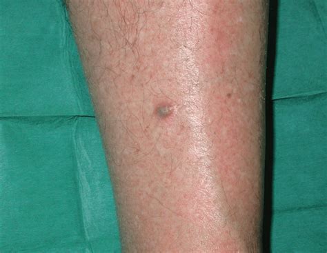 A Nodular Pigmented Lesion Rapidly Growing On Patients Leg Figure 1