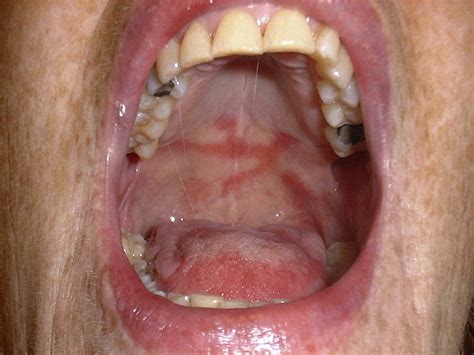 Glossitis With Linear Lesions An Early Sign Of Vitamin B12 Deficiency