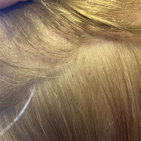 Top 100 Image Lice In Blonde Hair Vn