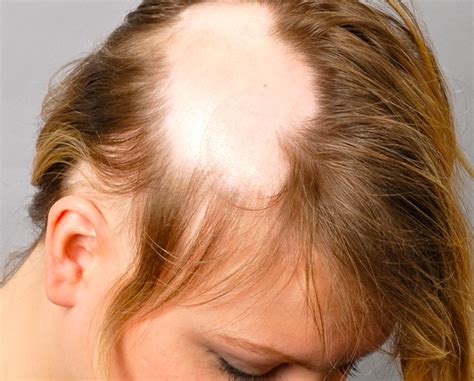 Alopecia is loss of hair that comes in a variety of patterns with a variety of causes, although often it is idiopathic. Tipi Alopecia Nelle Donne | Trapianto Capelli | CapilClinic 🥇