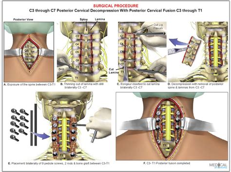4 Level C3 C7 Cervical Spine Decompression Surgical Procedure