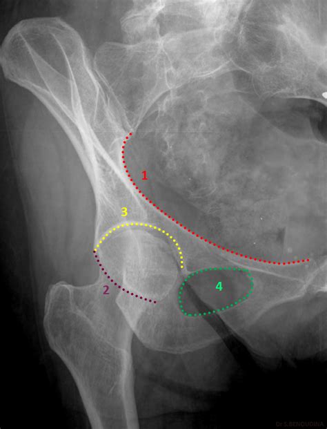 Adult Normal Pelvis Annotated Obturator Oblique View Image