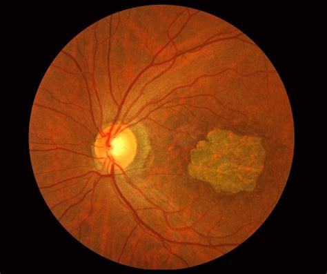 Stargardt Macular Dystrophy Slide 2 Retina Image Bank