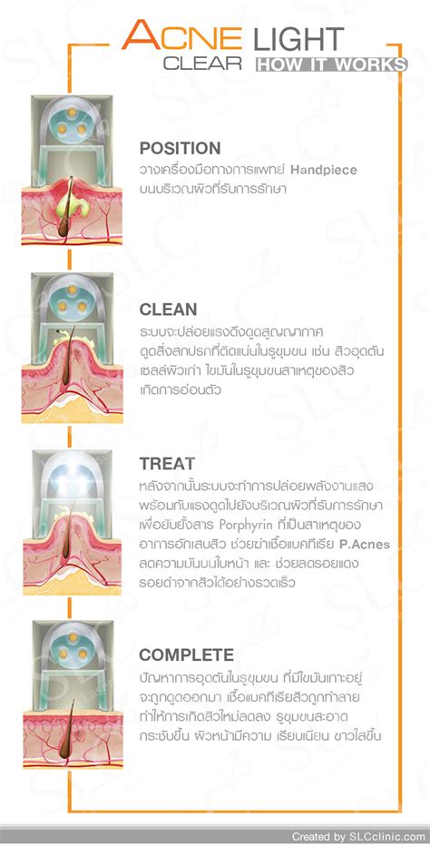Acne Clear Lightslc Siam Laser Clinic