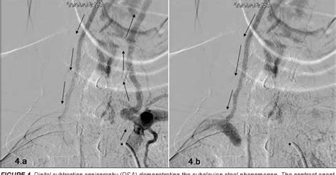Figure 4 From Subclavian Double Steal Syndrome Presenting With