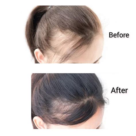 Bellahut Capixyl Hair Growth Additive With Capixyl