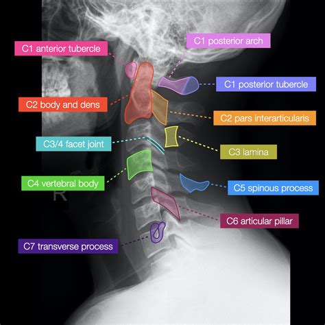 Normal Cervical Spine Radiographs Radiology Case Radiopaedia Org