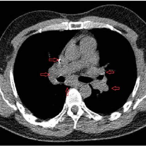 Ct Scan Of The Chest Showing Bihilar And Mediastinal Lymph Nodes