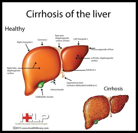 Maybe you would like to learn more about one of these? Pin on Cirrhosis Of The Liver Alcohol Abuse
