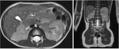 Figure 3 From Extensive Synchronous Bilateral Wilms Tumor Treated With