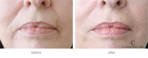 Dermal Fillers Before And After Gallery