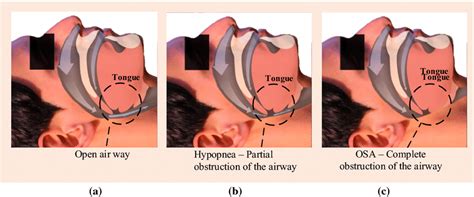 Upper Airway Muscles During A Normal Breathing B Hypopnea And C