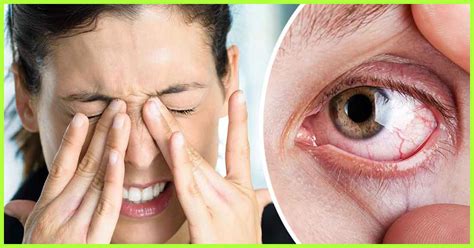 Sindrome Dell Occhio Secco Sintomi Cause E Quando Andare Dal Medico