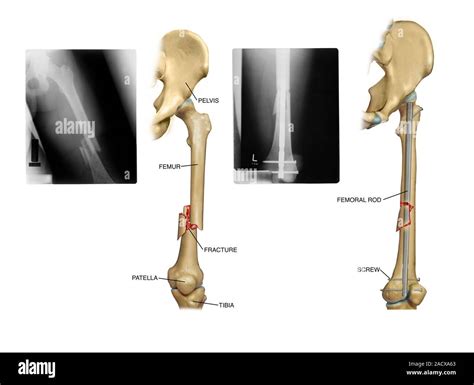 Internal Fixation Of Fractured Femur Labelled Artworks And