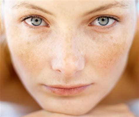 How To Get Rid Of Sunspots On Your Face Fast Naturally A Listly List