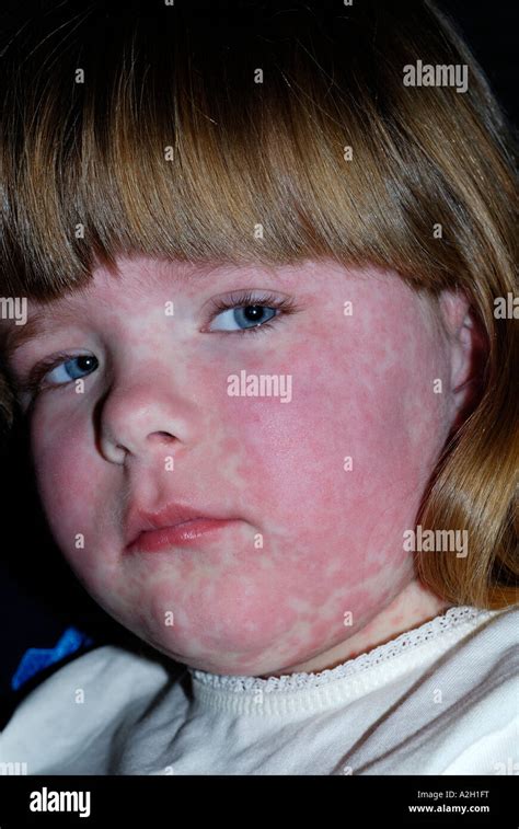 Allergic Reaction To Penicillin High Resolution Stock Photography And