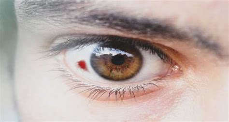 Another Symptom Of Corona Virus Blood Clots Forming In The Eyes You