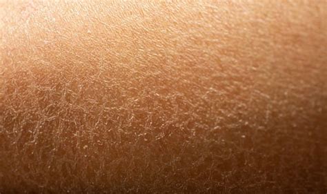 Type 2 Diabetes Symptoms Dry Skin Could Be A Sign Of The Condition